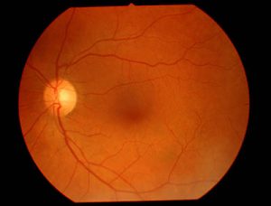 retinal disease